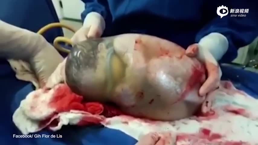 西班牙产妇产下“巨蛋” 婴儿裹羊膜囊中出生