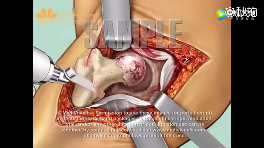 好真实的3d动画骨外科手术过程展示