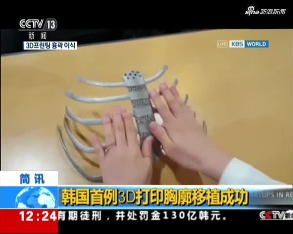 视频：韩国首例3D打印胸廓移植成功