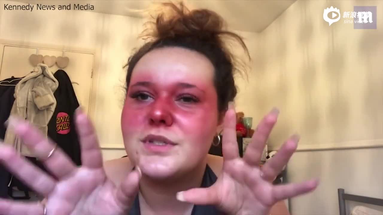 视频-英女孩得狼疮遭霸凌 拍化妆视频帮助病友找自