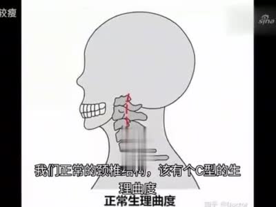 你想要的天鹅颈,只不过是颈椎生理曲度变直