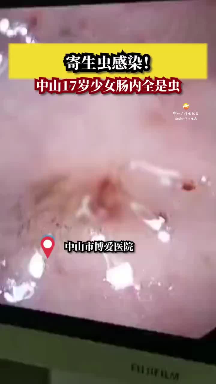 广东中山17岁女生肠内全是蠕动的活虫,只因爱吃生鱼