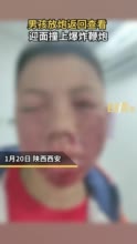 男孩放炮没响返回查看撞上爆炸 医生：好在送医及时并无大碍