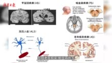 基因治疗能有效改善大动物模型神经退行性疾病