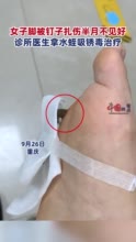 女子脚被钉子扎伤医生用蚂蟥吸锈毒：全程不敢看，治疗效果还挺好