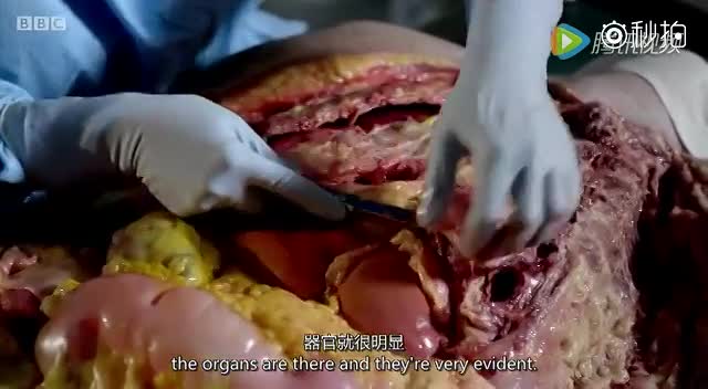 解剖肥胖者的纪录片图片