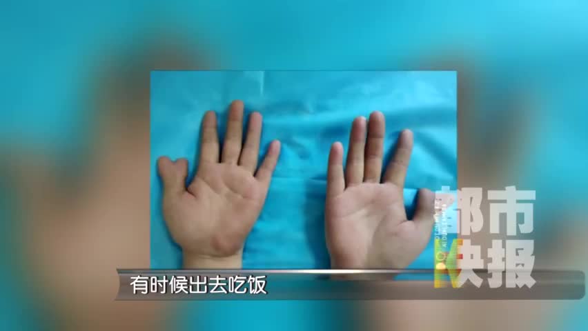 视频：少女长出心形拇指 “藏手”18年终做手术恢