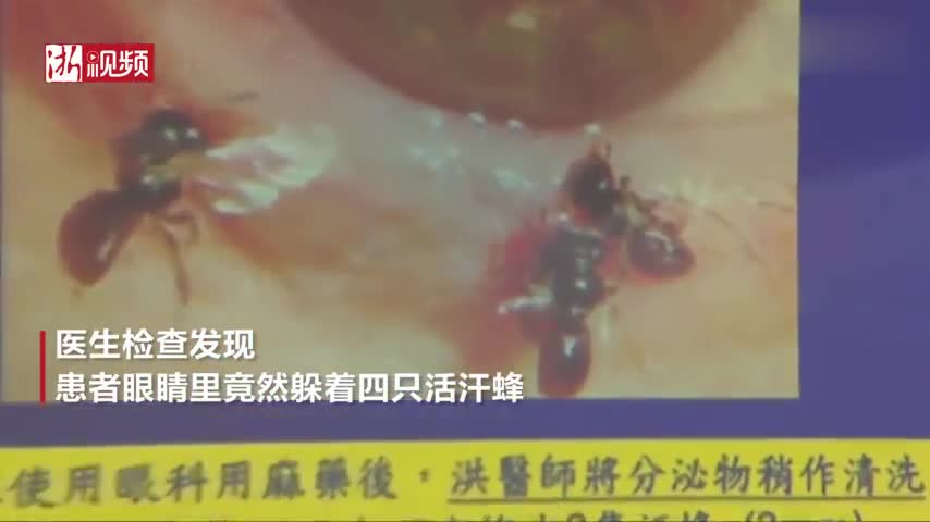 视频-台湾女子眼睛里发现4只活汗蜂 险些失明