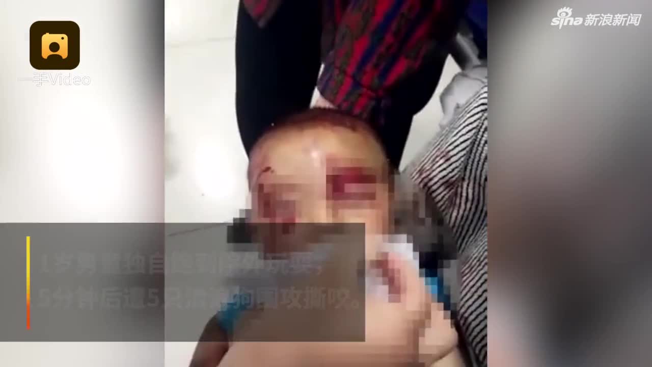 视频：1岁男童遭5只流浪狗围攻撕咬 全身80%被