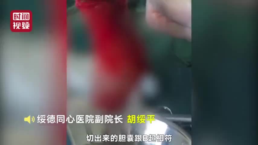 视频：男子腹痛难忍去医院 竟从体内取出500多粒