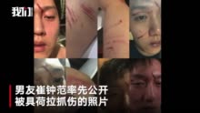 具荷拉一生黑:2分钟看具荷拉一生:被男友家暴患上抑郁症 曾未遂
