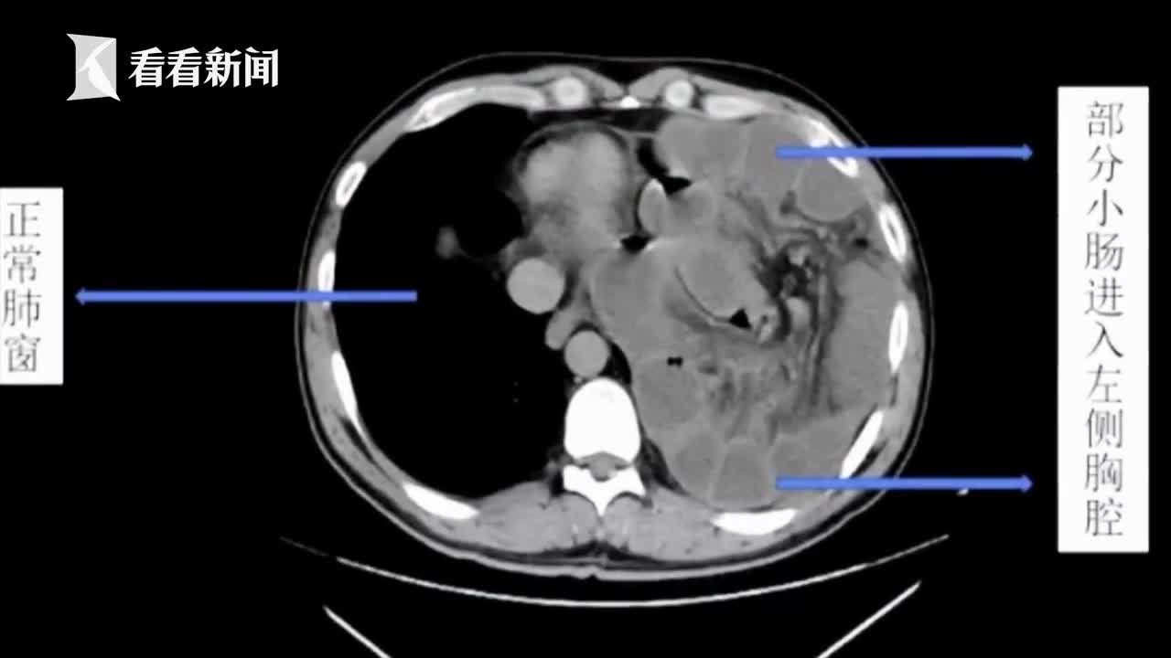 男子突然腹痛难忍一查竟是2米小肠 钻 进胸腔 腹痛 外科 新浪新闻