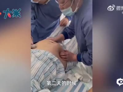 1分钟！医生隔着准妈妈肚皮将宝宝调了个头